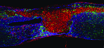 Taking on Spinal Cord Injury